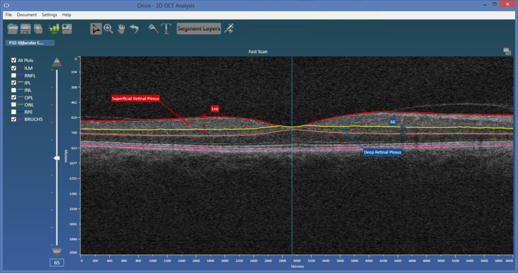 The above shows the superficial and deep retinal plexi correctly defined using our OrionTM software (compatible with Zeiss, Optovue and Topcon devices).
